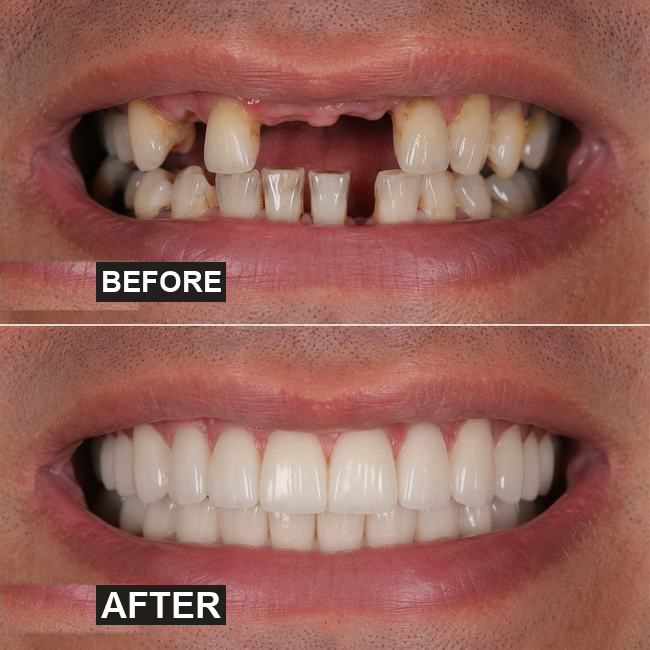 Illustrative before-and-after dental implant image, case 1