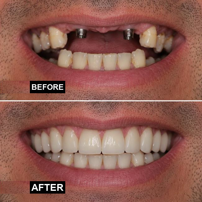Illustrative before-and-after dental implant image, case 2