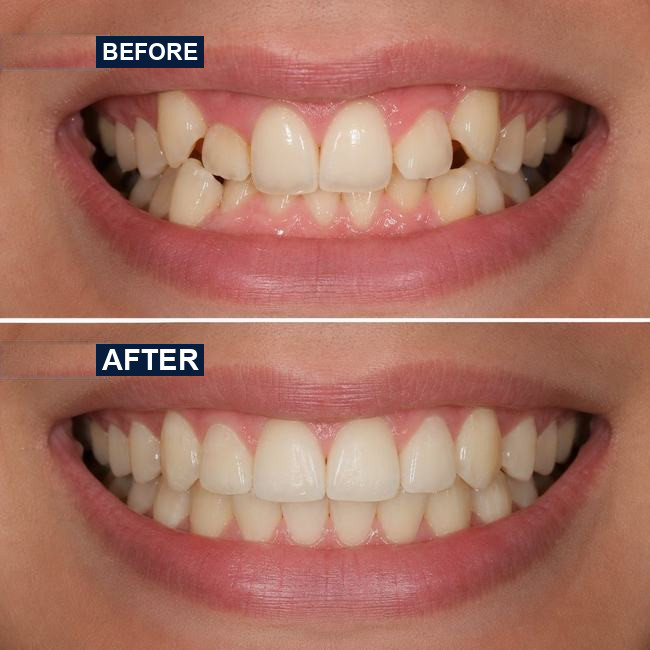 Illustrative before-and-after dental implant image, case 4